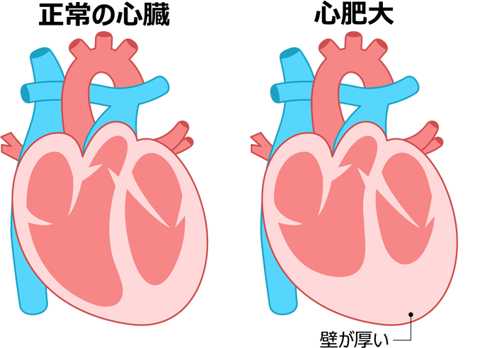 心肥大とは？