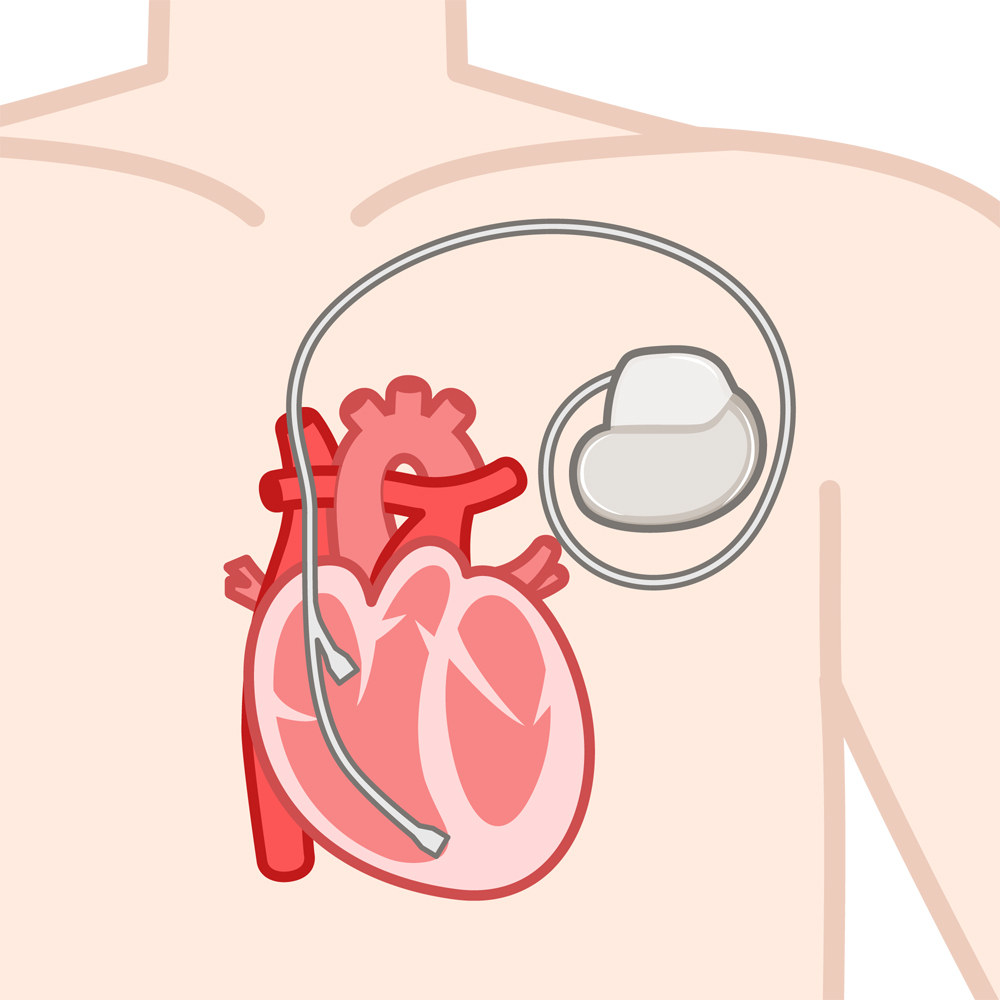 ペースメーカー管理にも対応しています